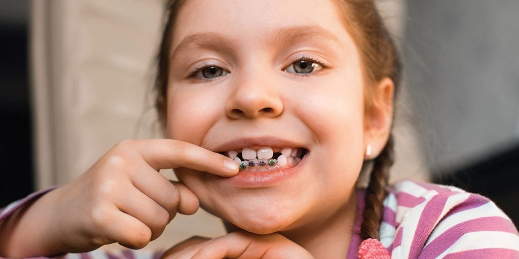 How to Fix Missing Teeth – Metal Braces, Dental Implants, Or a Dental Crown
