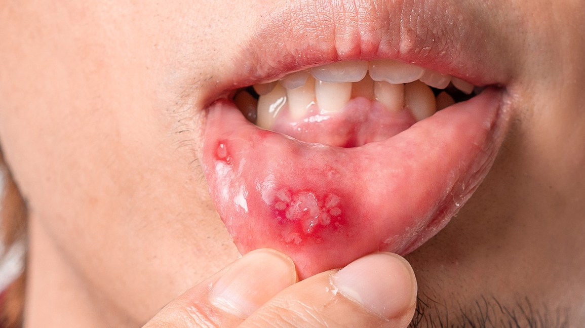 How to Treat a Canker Sore on Lips